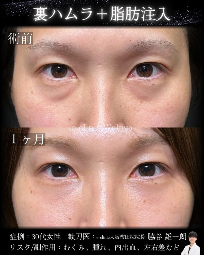 裏ハムラ法と脂肪注入の症例写真