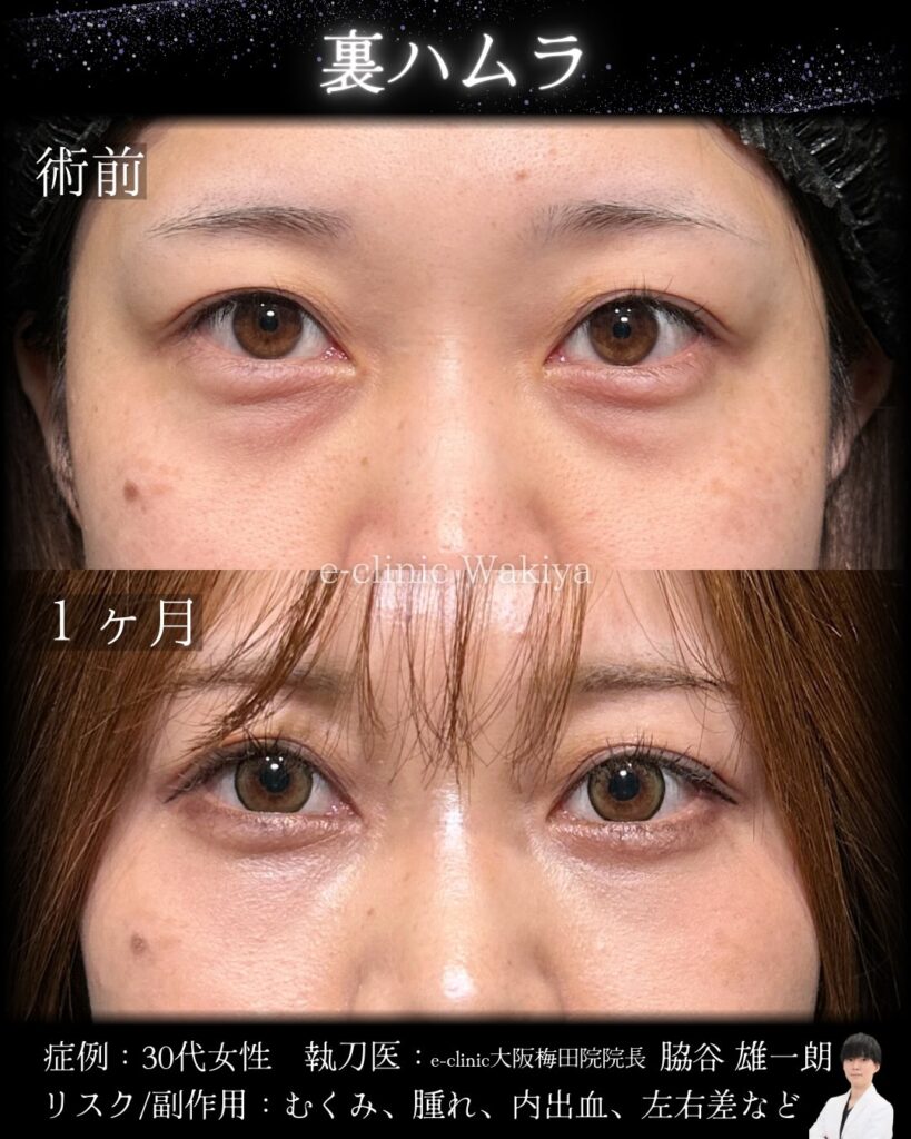 裏ハムラ法の症例写真 (16)