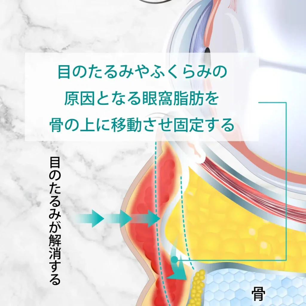 eクリニック大阪梅田院の裏ハムラ法（眼窩脂肪の図解）
（名医の脇谷雄一朗医師が執刀）