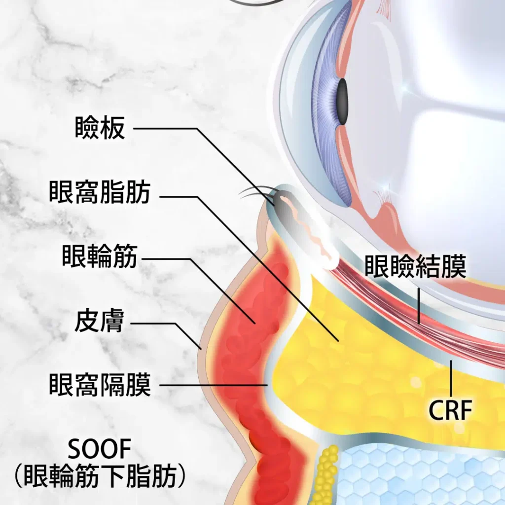 eクリニック大阪梅田院の裏ハムラ法（眼窩脂肪の図解）
（名医の脇谷雄一朗医師が執刀）