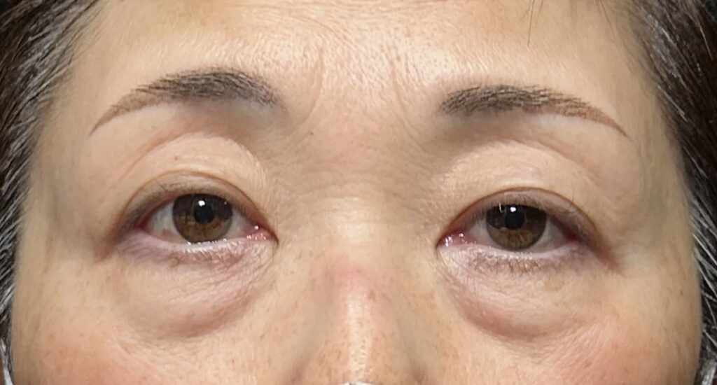 eクリニック大阪梅田院のクマ取り表ハムラ法の症例術前写真(名医の脇谷雄一朗医師が執刀)