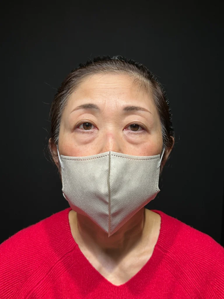 eクリニック大阪梅田院のクマ取り表ハムラ法の症例術前写真(名医の脇谷雄一朗医師が執刀)