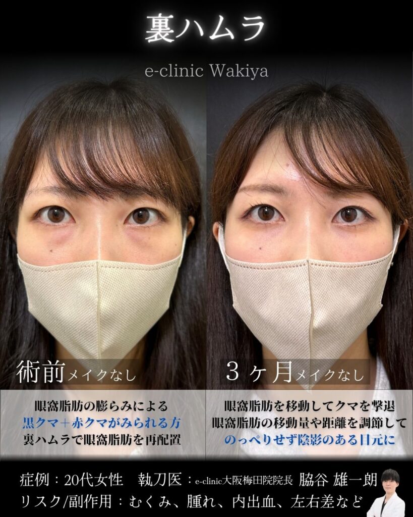 大阪の脇谷雄一朗医師の裏ハムラの20代女性の症例解説