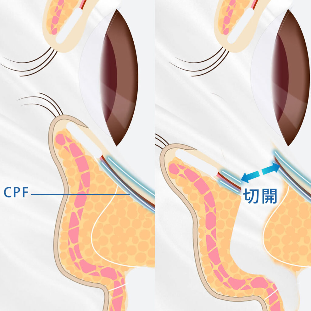 裏ハムラでCRFを切開する図解
