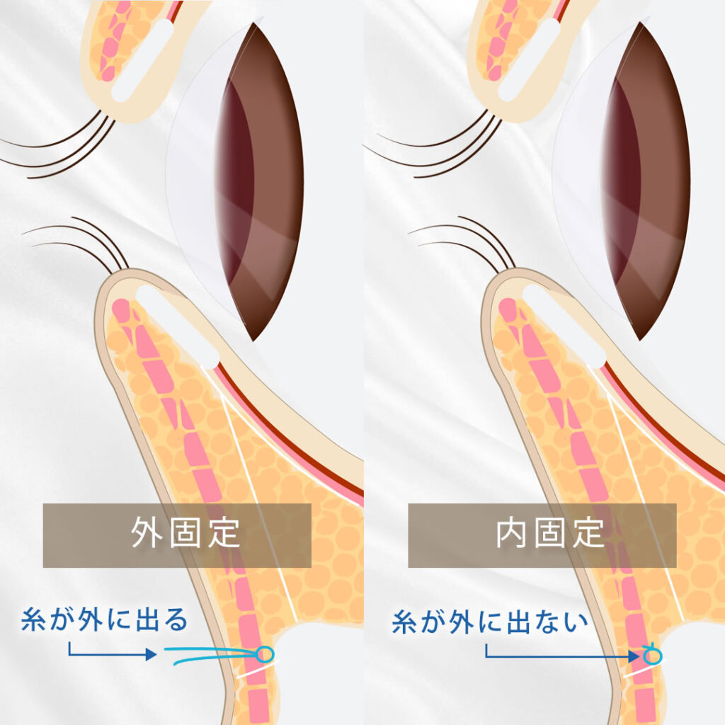 裏ハムラの内固定と外固定の違い