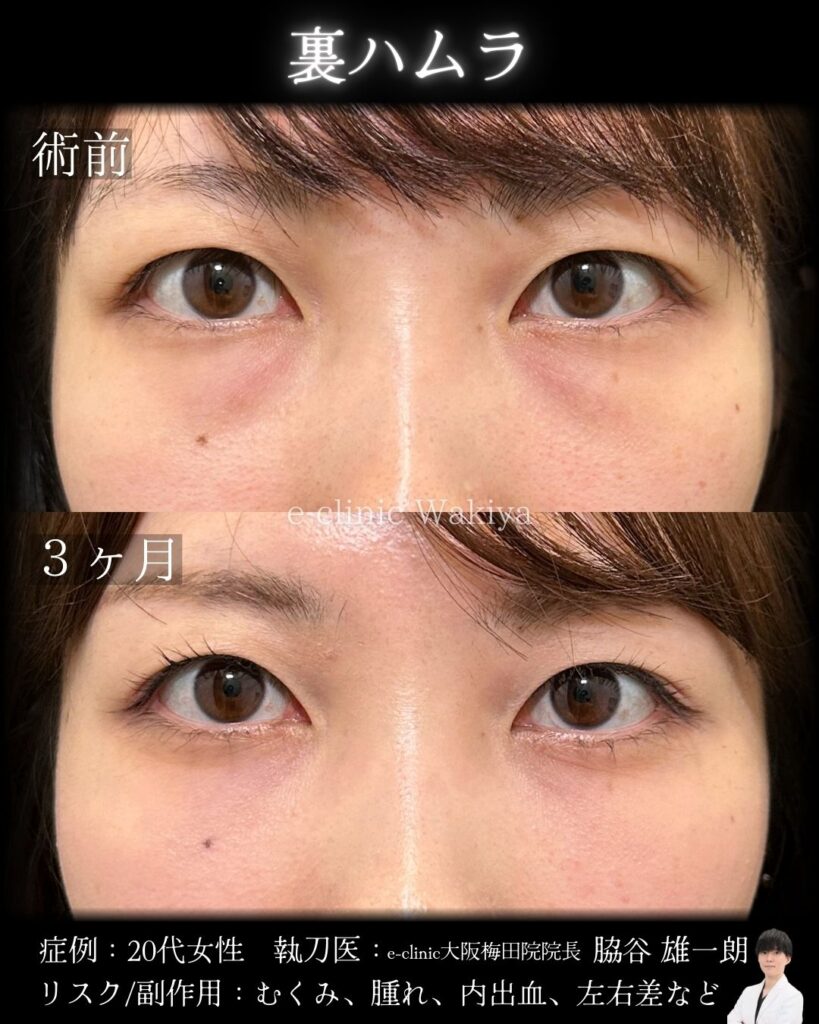 eクリニックの大阪梅田院のクマ取り 裏ハムラ法の症例写真 (名医の脇谷雄一朗医師が執刀）