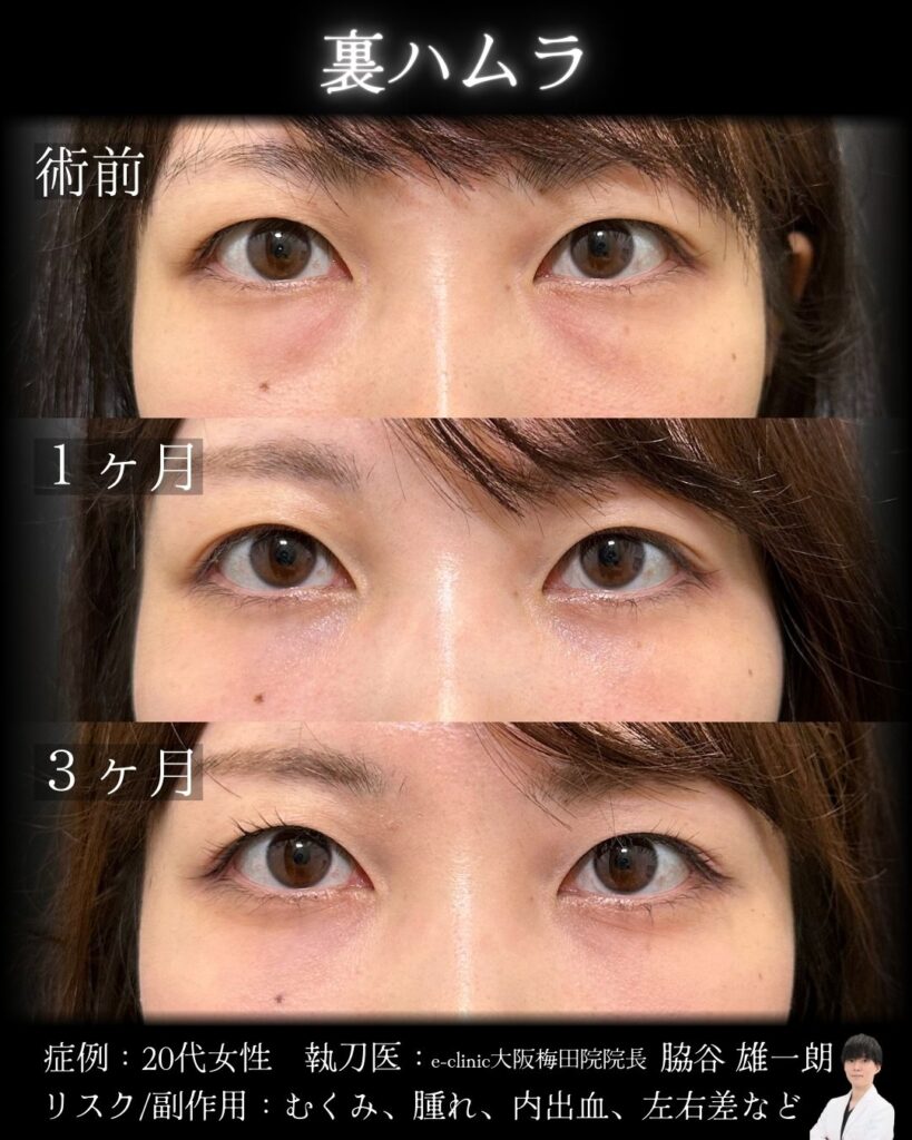 大阪の脇谷医師の裏ハムラの20代女性の症例写真