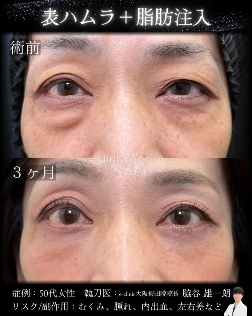 eクリニックの大阪梅田院のクマ取り 表ハムラ法の症例写真 (名医の脇谷雄一朗医師が執刀）