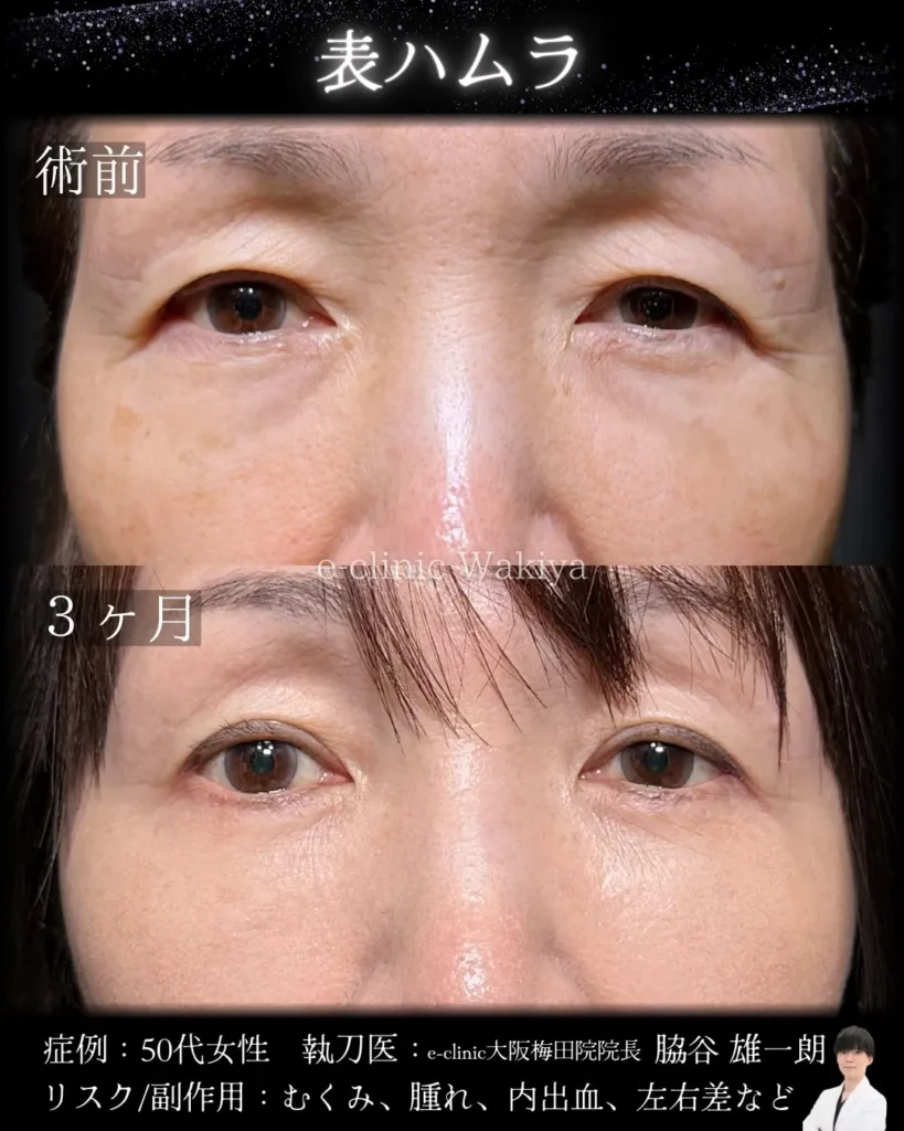 eクリニックの大阪梅田院のクマ取り 表ハムラ法の症例写真 (名医の脇谷雄一朗医師が執刀）