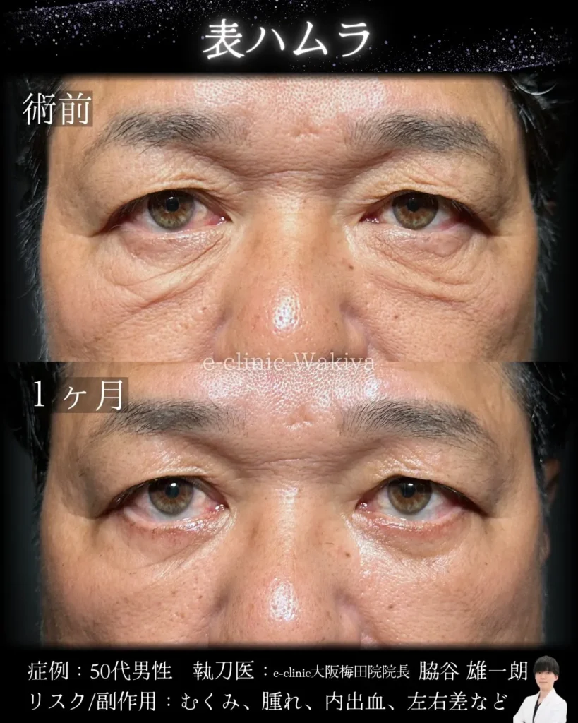 eクリニックの大阪梅田院のクマ取り 表ハムラ法の症例写真 (名医の脇谷雄一朗医師が執刀）