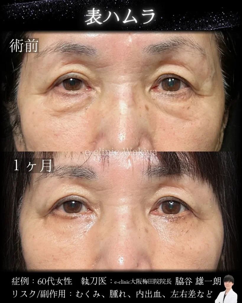 eクリニックの大阪梅田院のクマ取り 表ハムラ法の症例写真 (名医の脇谷雄一朗医師が執刀）