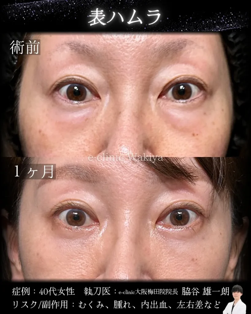 eクリニックの大阪梅田院のクマ取り 表ハムラ法の症例写真 (名医の脇谷雄一朗医師が執刀）