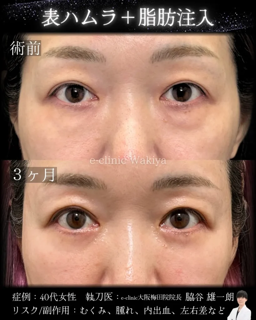 eクリニックの大阪梅田院のクマ取り 表ハムラ法の症例写真 (名医の脇谷雄一朗医師が執刀）