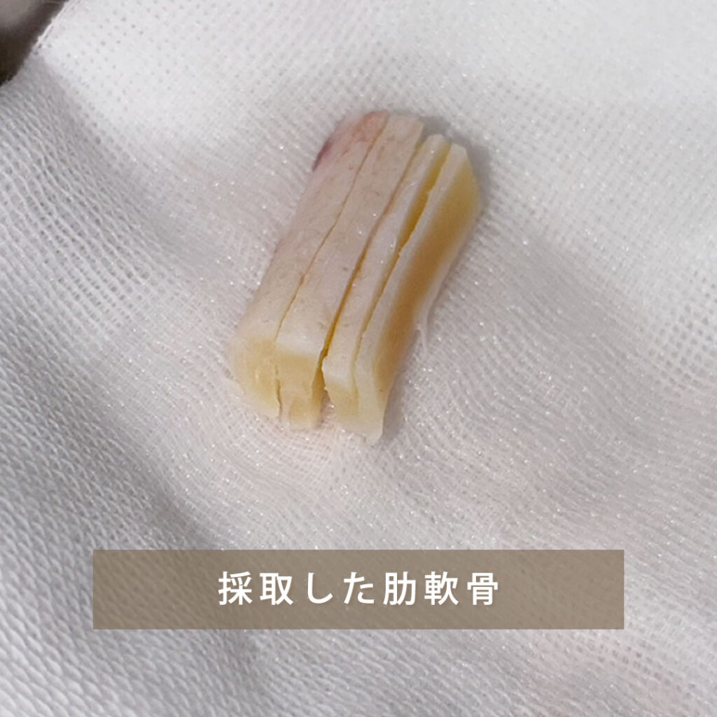 採取した鼻整形用の肋軟骨