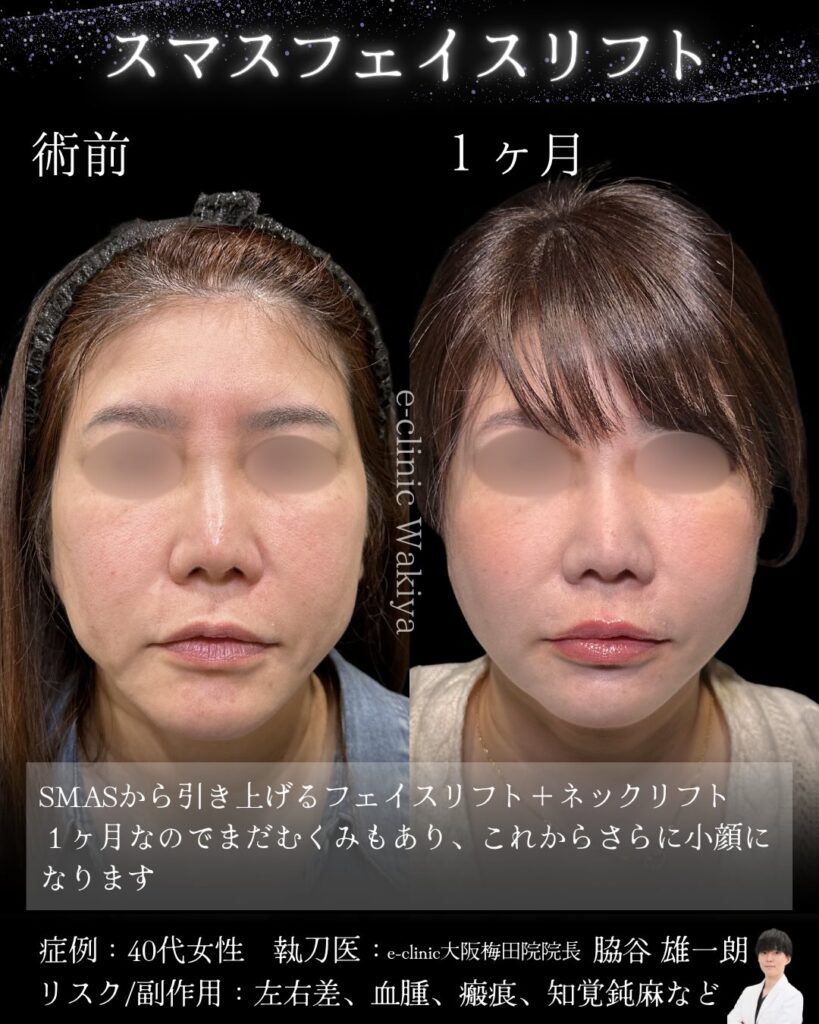 スマスフェイスリフトの症例写真 (4)