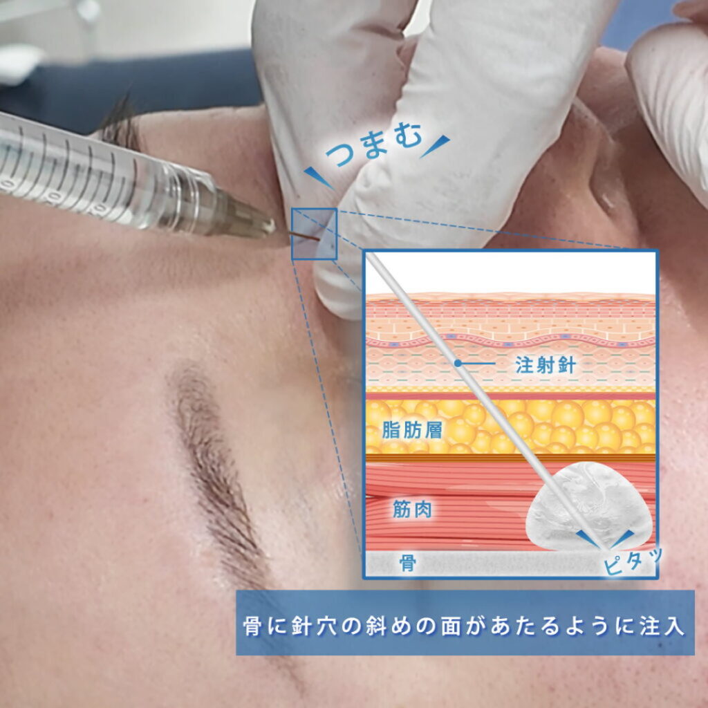 20代の鼻根のヒアルロン酸を横からみた症例写真