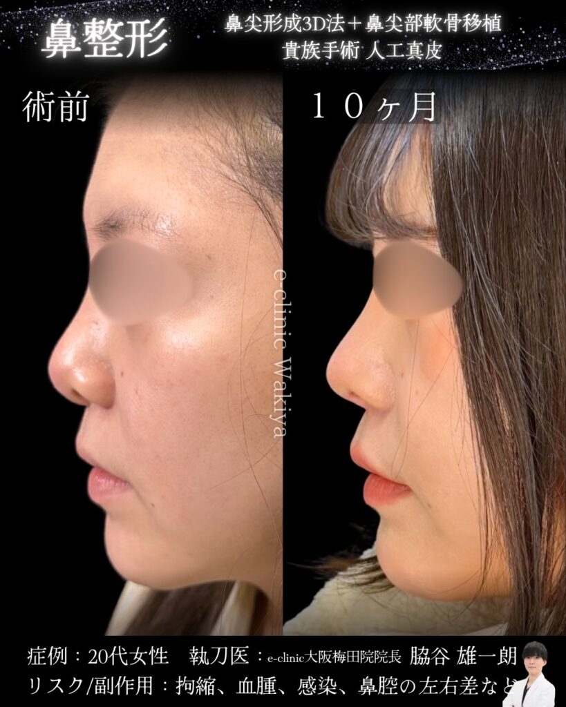 鼻尖形成と軟骨移植と人工真皮の症例写真