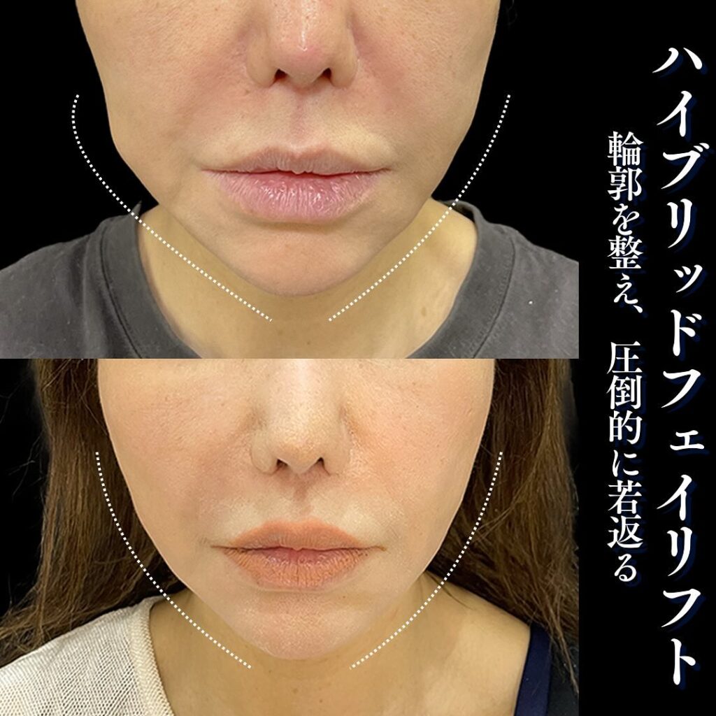 ハイブリットフェイスリフトの症例写真 (2)