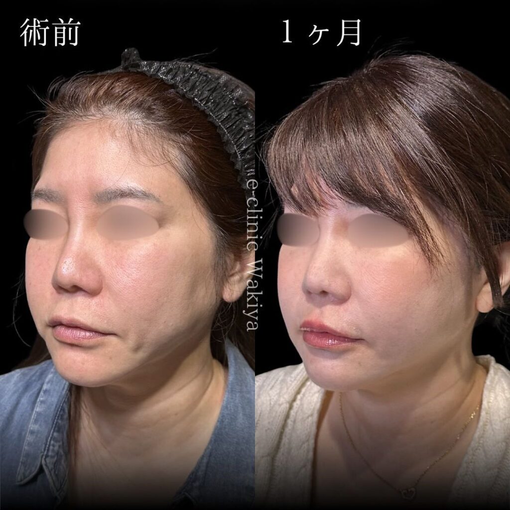 スマスフェイスリフトの症例写真