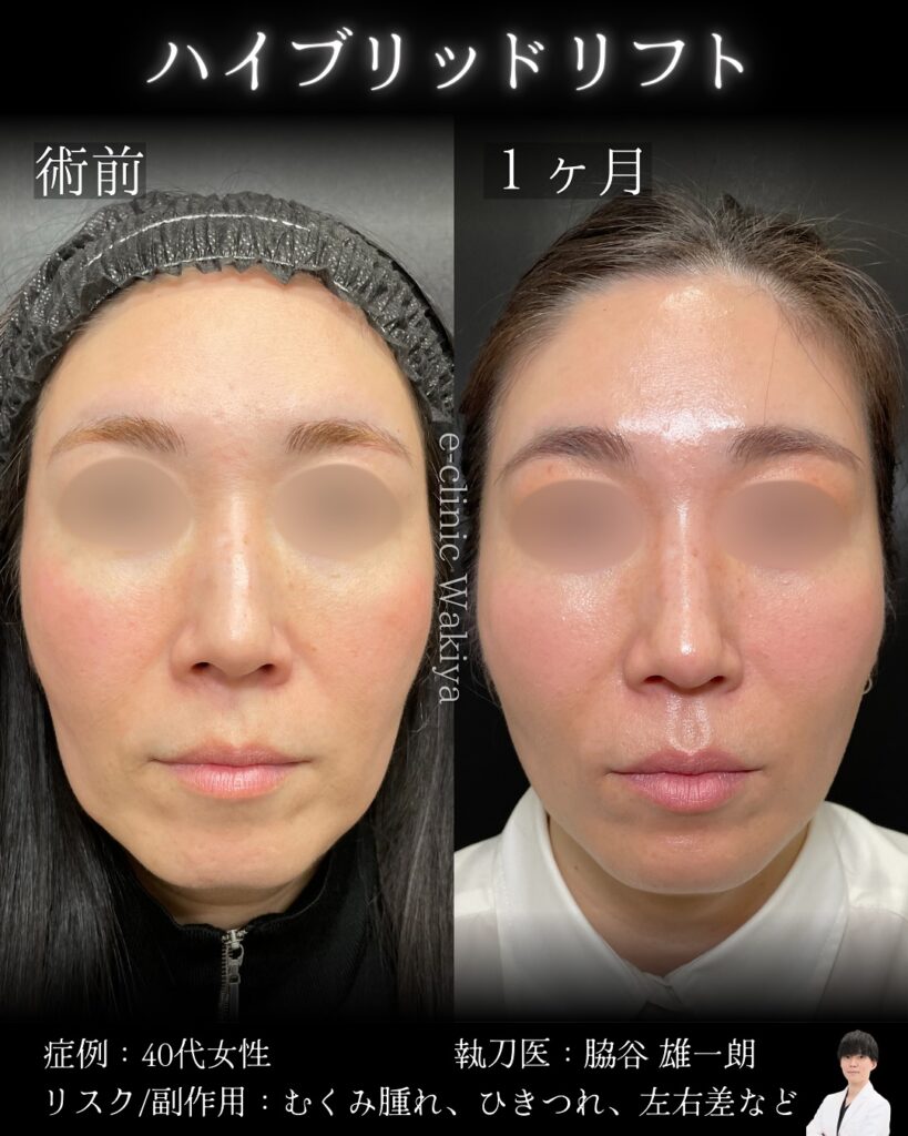 ハイブリットフェイスリフトの症例写真