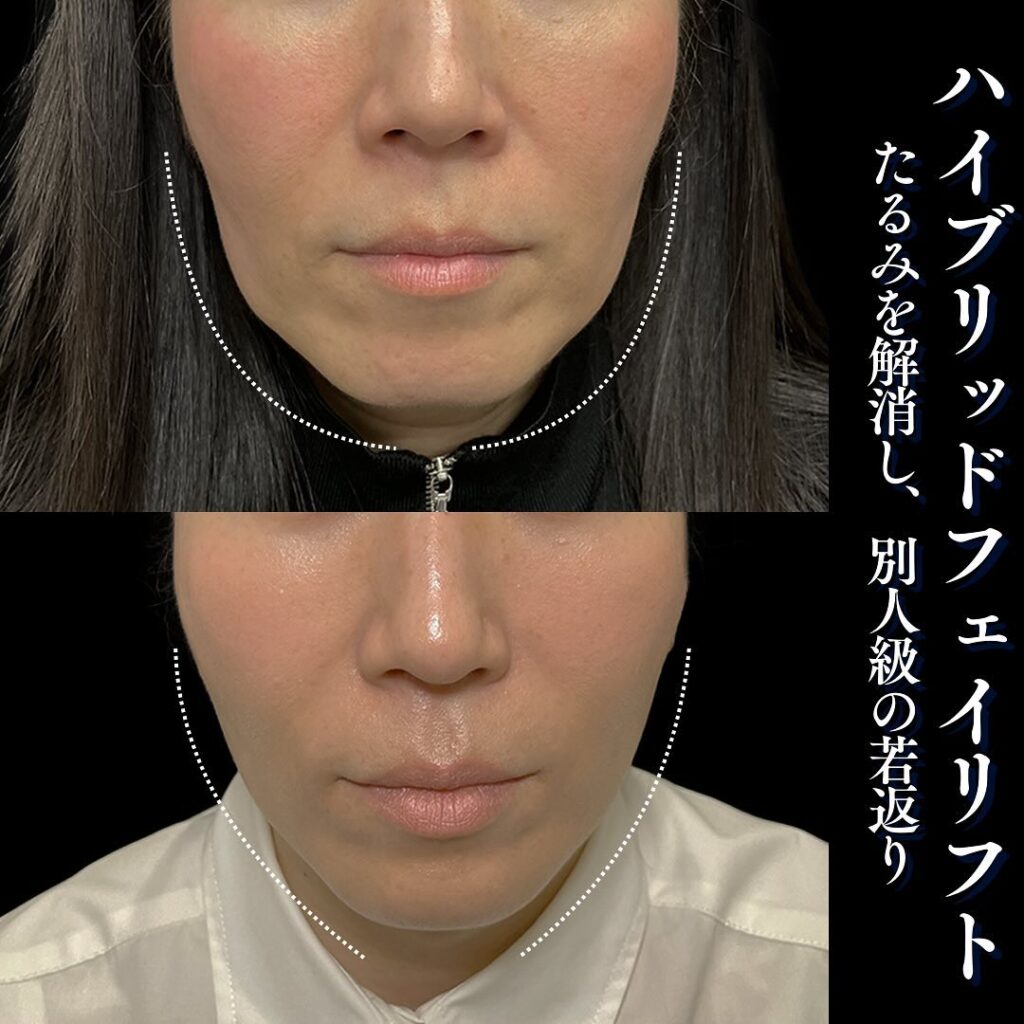 ハイブリットフェイスリフトの症例写真 (1)