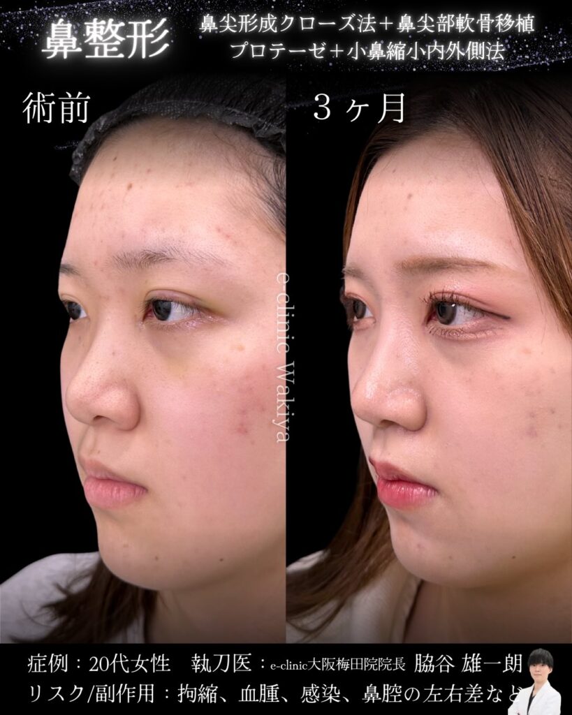 鼻尖形成と軟骨移植とプロテーゼと小鼻縮小の症例写真