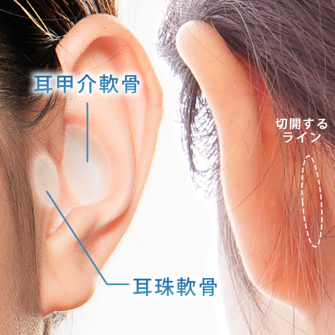 耳介軟骨のイメージ