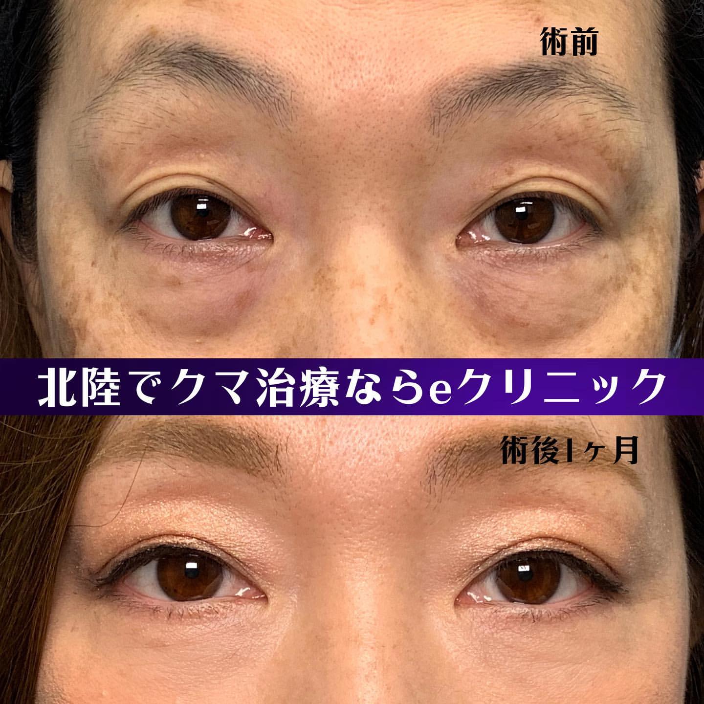裏ハムラ法で目の下のクマを改善した女性